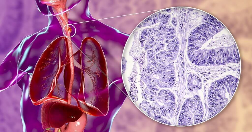 breast cancer in lymph nodes diagnosis