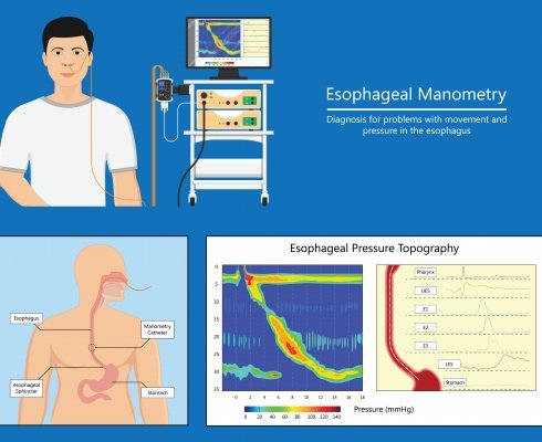 Esophageal manometry test esophageal diagnose food high resolution; blog: When is Manometry Used?