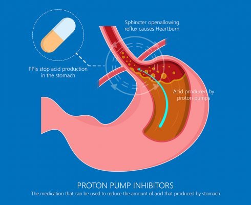 Proton pump inhibitors drugs medication for treatment stomach ac; blog: 4 GERD Treatment options