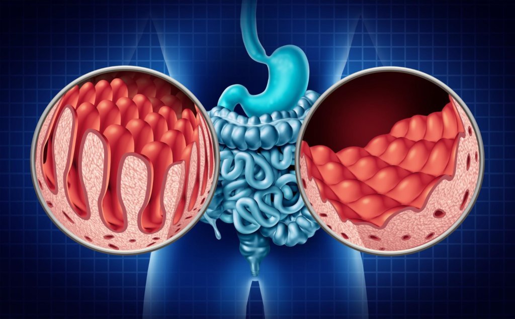 a diagram showing the inflammation associated with celiac disease