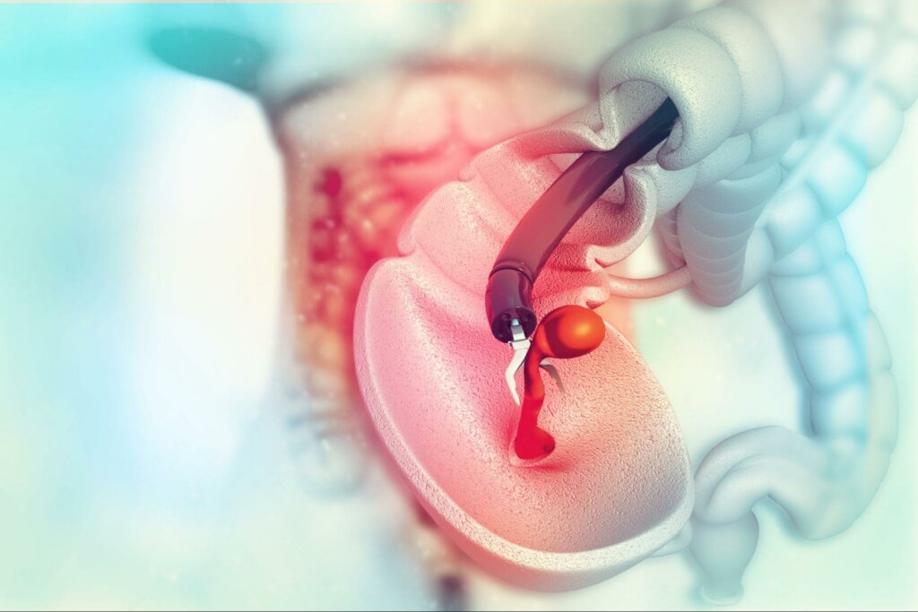 digital illustration of a colonoscopy to represent how to prepare for your colonoscopy