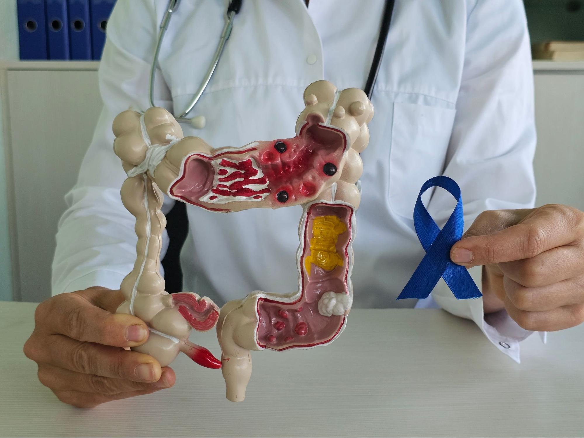 Early Signs and Symptoms of Colorectal Cancer You Shouldn't Ignore -  Birmingham Gastroenterology Associates